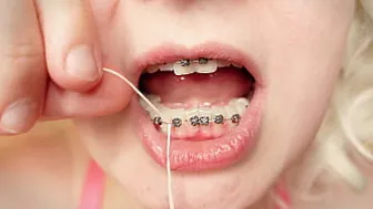 2nd Day In Braces - Dental Floss - Close Up Mouth Tour