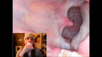 Clips 4 Sale - Endoscopy Catarrh Saliva And Mouth Exploration 1080HD