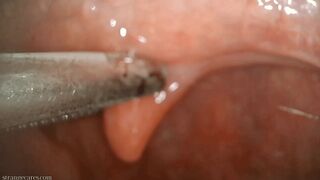 Clips 4 Sale - uvula manipulation with swab and forceps (720 mp4)